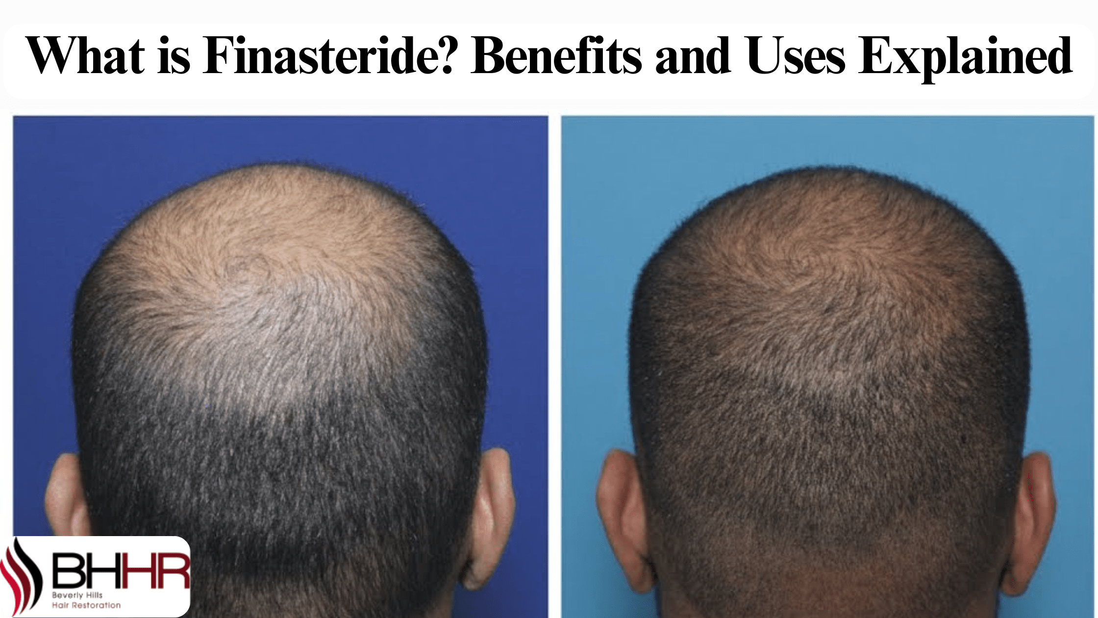 What is finasteride